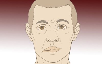 Acupuncture for Bell’s Palsy