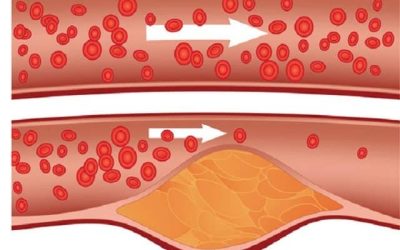 Tips for Lowering Cholesterol