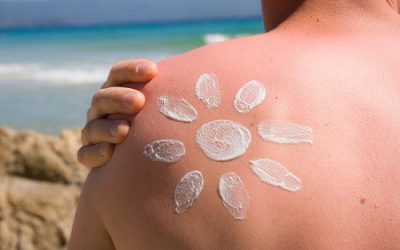 Sunburn: Best Remedies, Treatments, Solutions