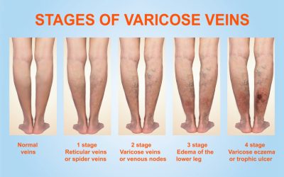 Treating Varicose Veins Naturally