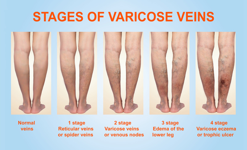 Treating Varicose Veins Naturally
